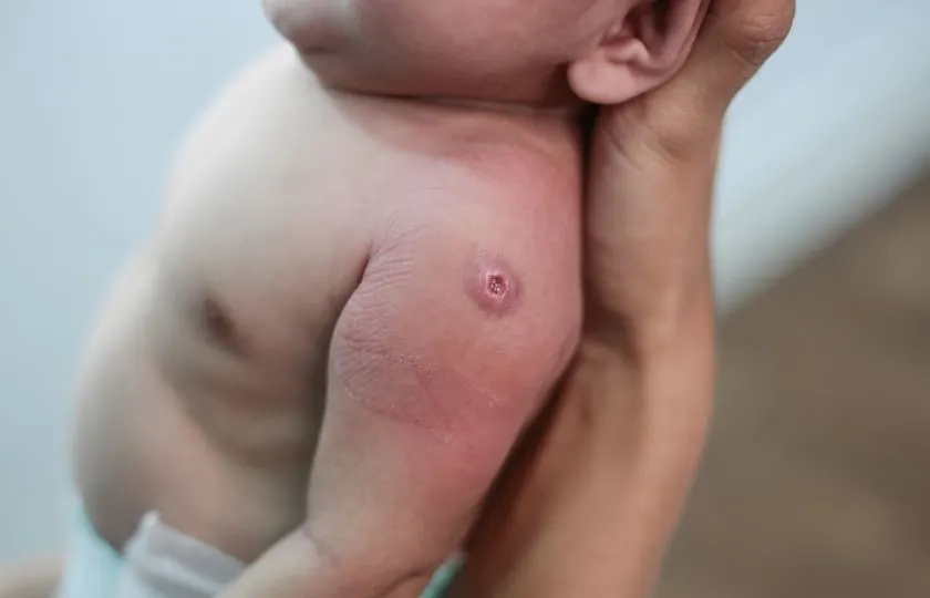 Therapielaser, Stillen Köln, Therapielaser Verleih, Steffi Weiss, Wunden, etc.