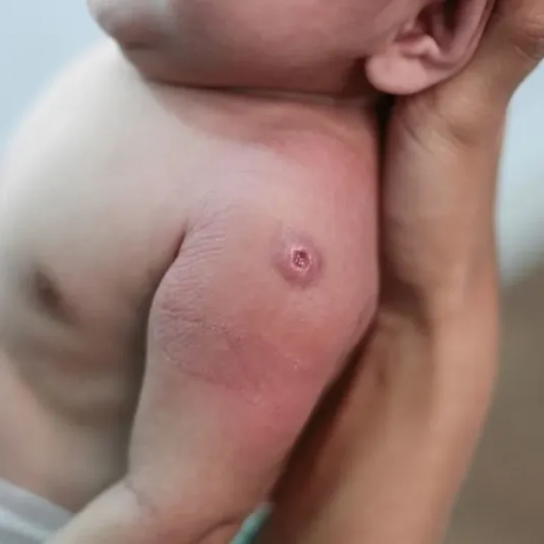 Therapielaser, Stillen Köln, Therapielaser Verleih, Steffi Weiss, Wunden, etc.